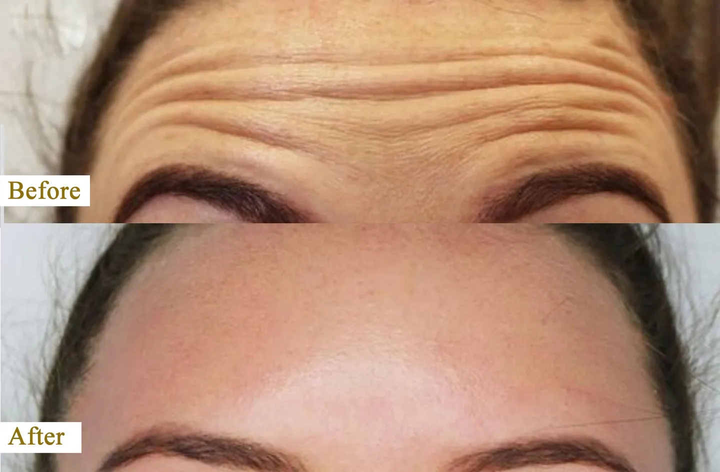 Anti-Wrinkle Treatment