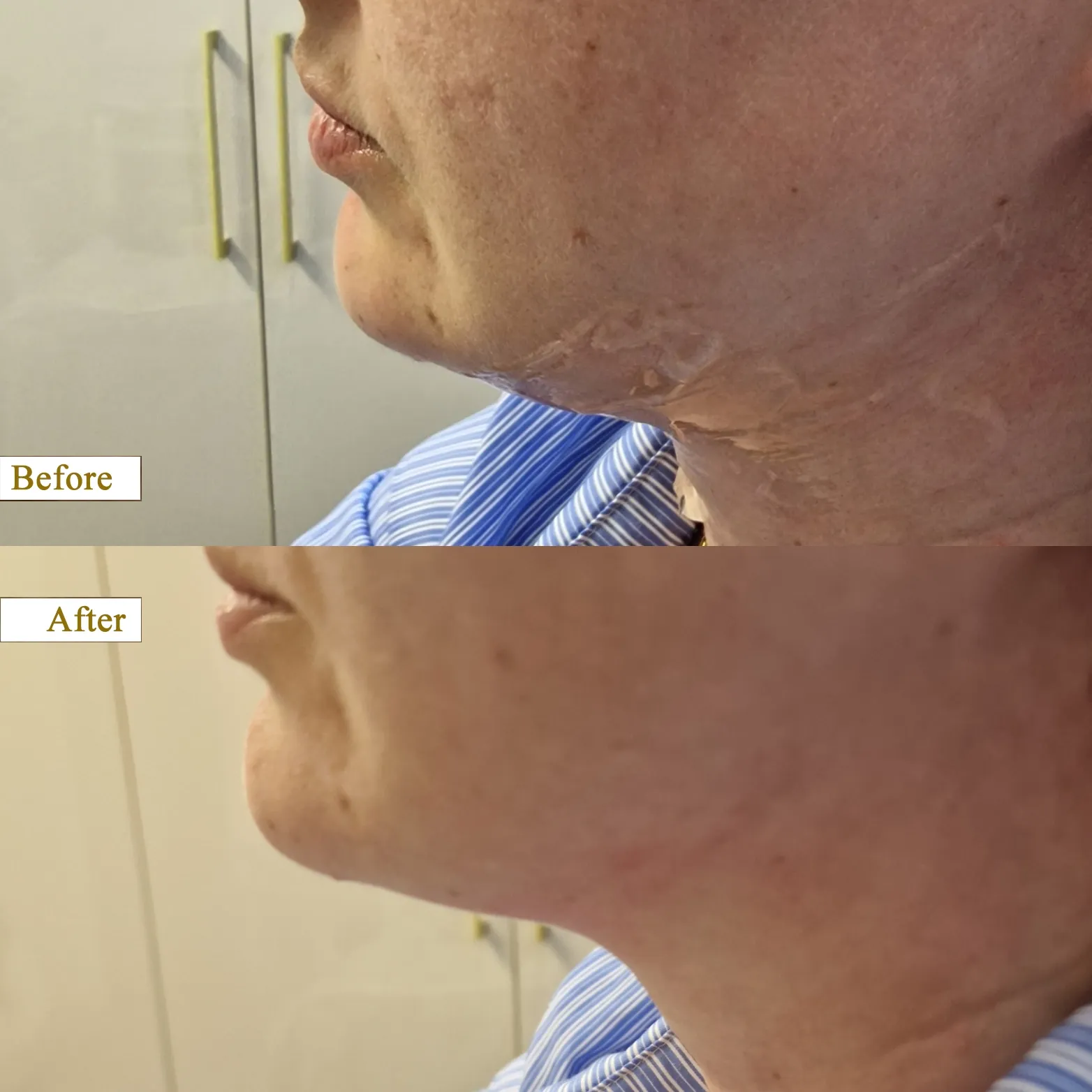HIFU Treatment