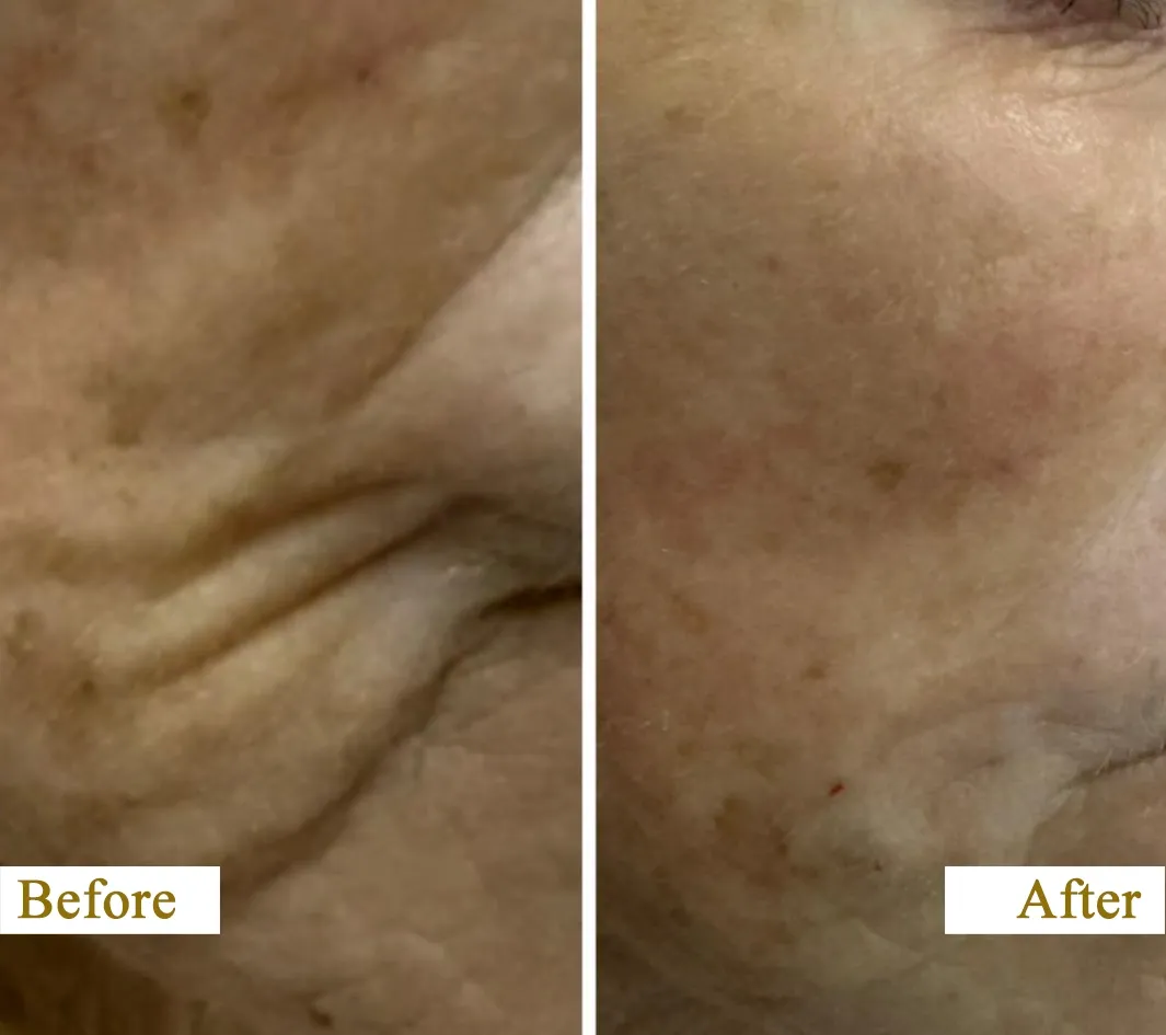 Skin Rejuvenation