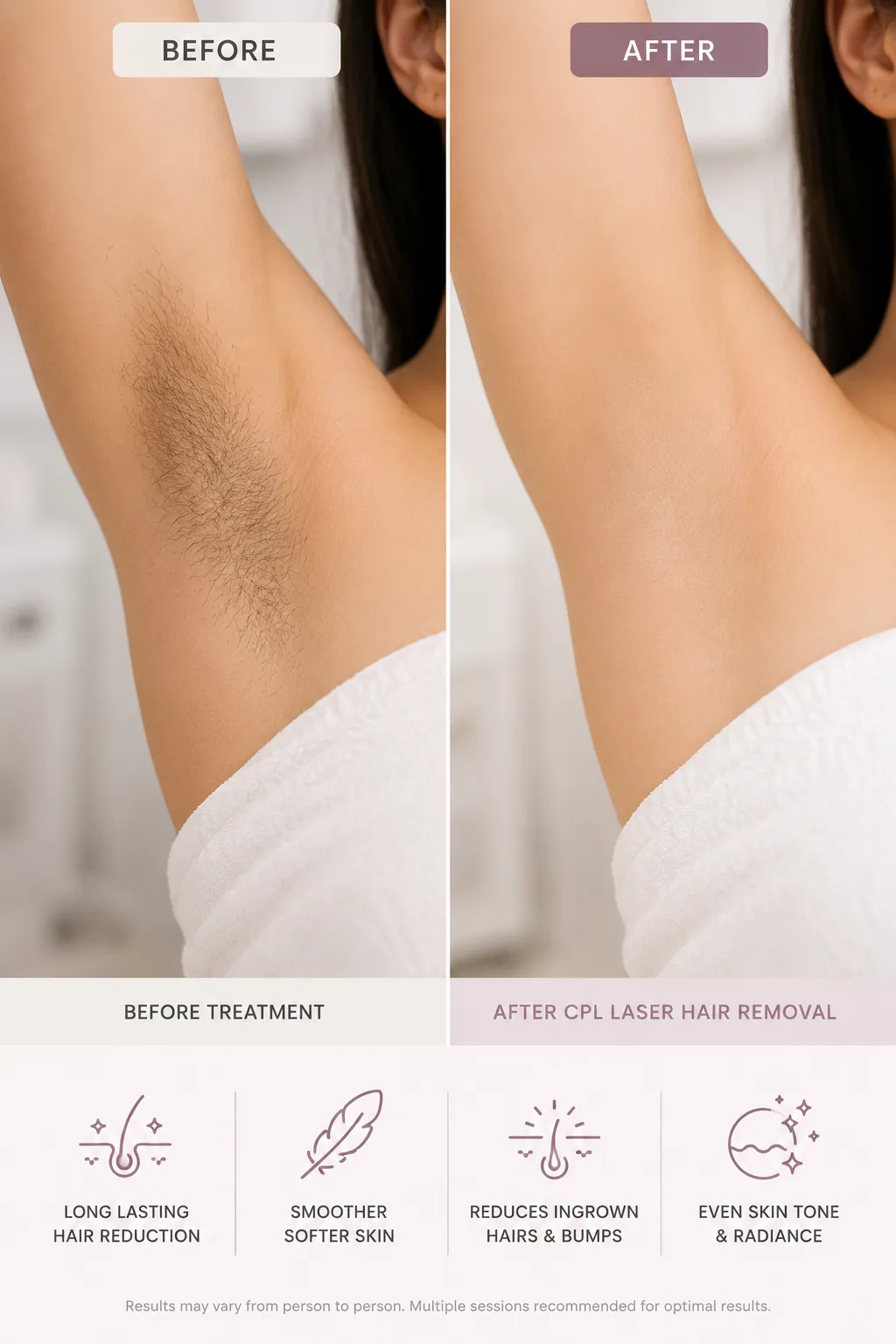 CPL Laser Hair Removal weybridge after before
