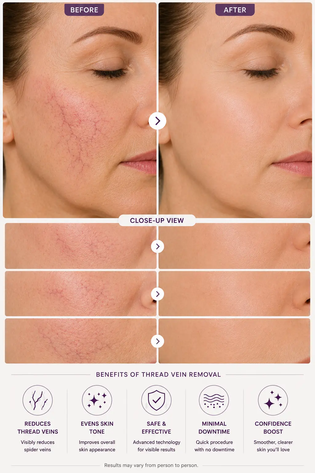 Thread Vein Weybridge before after